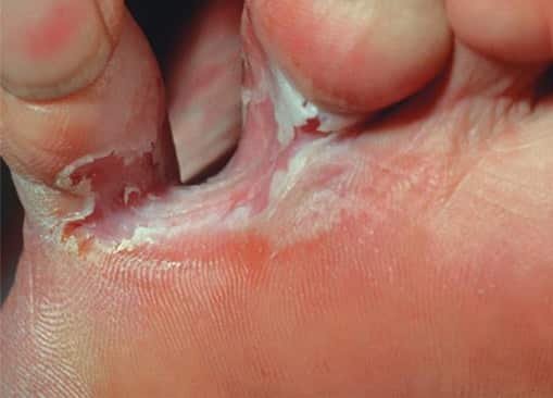 Athlete's Foot