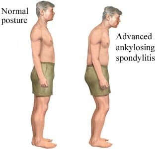 Bent Posture
