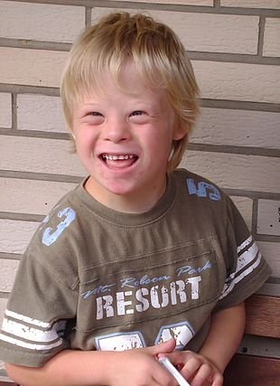 Down Syndrome Child