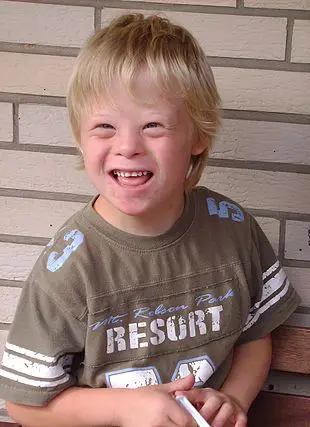 Down Syndrome Child