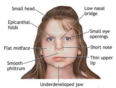 "alcohol-syndrome/diagnosis-treatment/drc-20352907