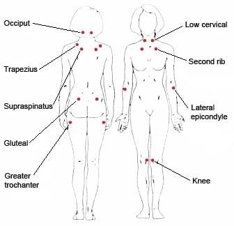 Fibromyalgia