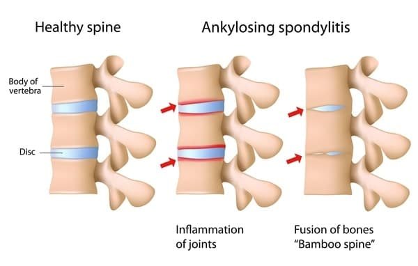 Fusion Of Bones