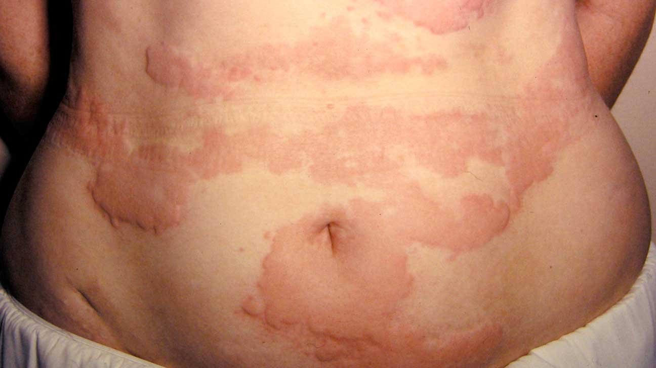Generalized Urticaria