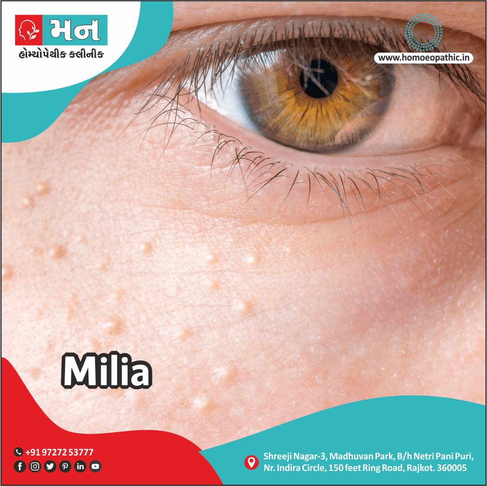 Milia Definition Symptoms Cause Diet Regimen Homeopathic Medicine Homeopath Treatment in Rajkot India