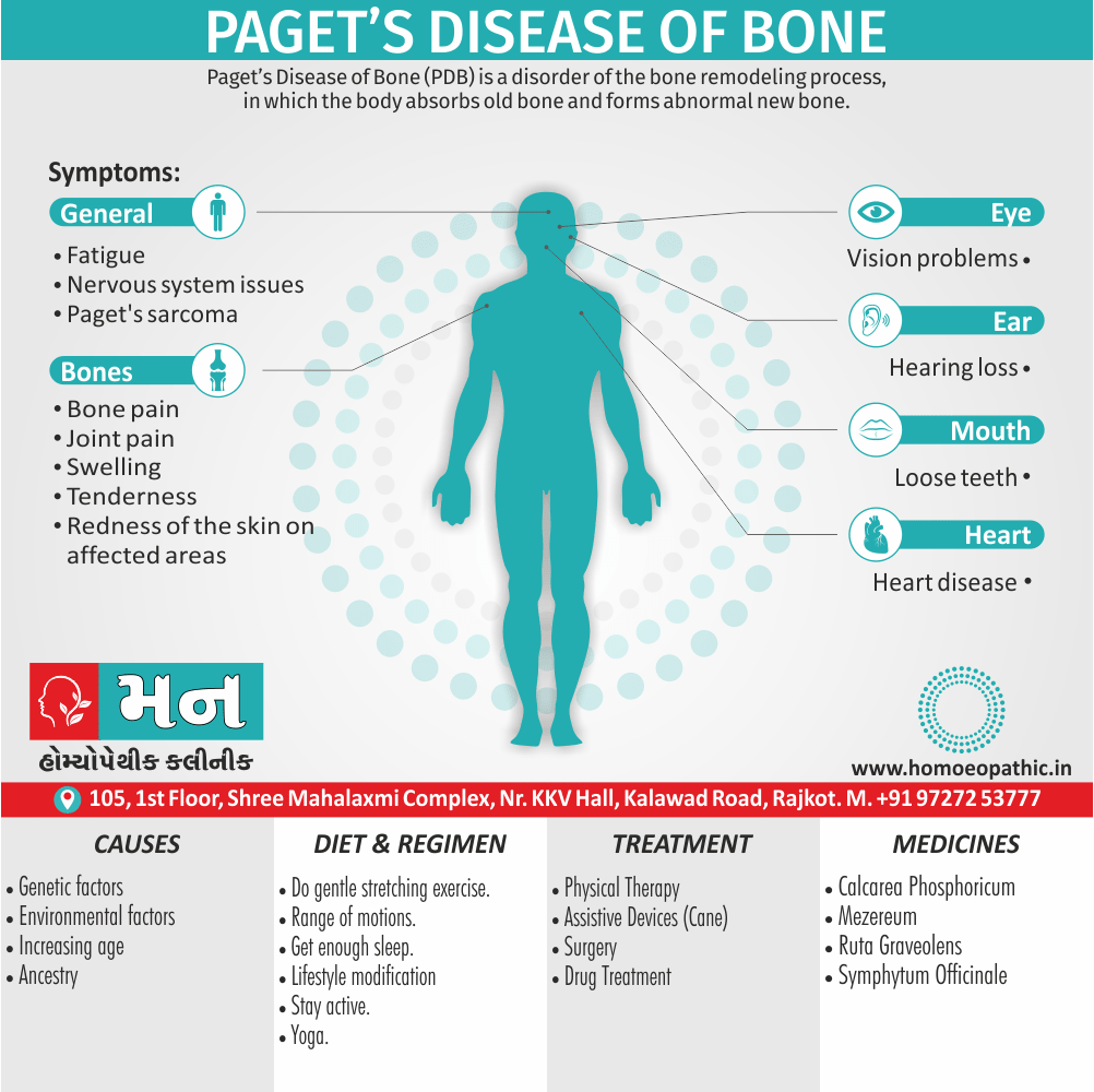 Paget’s Disease Of Bone Definition Symptoms Cause Diet Regimen Homeopathic Medicine Homeopath Treatment In Rajkot India