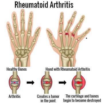 Rheumatoid Arthritis