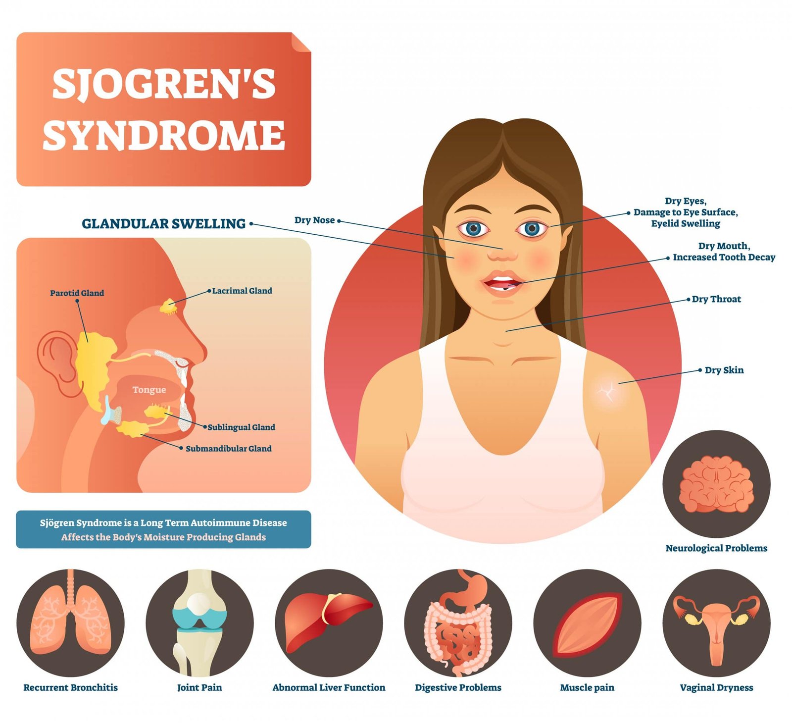 Sj&ouml;gren&rsquo;s Syndrome