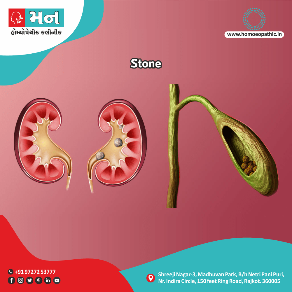 પથરી Stone Definition Symptoms Cause Diet Homeopathic Medicine Treatment Homeopathy Doctor Clinic in Rajkot Gujarat India