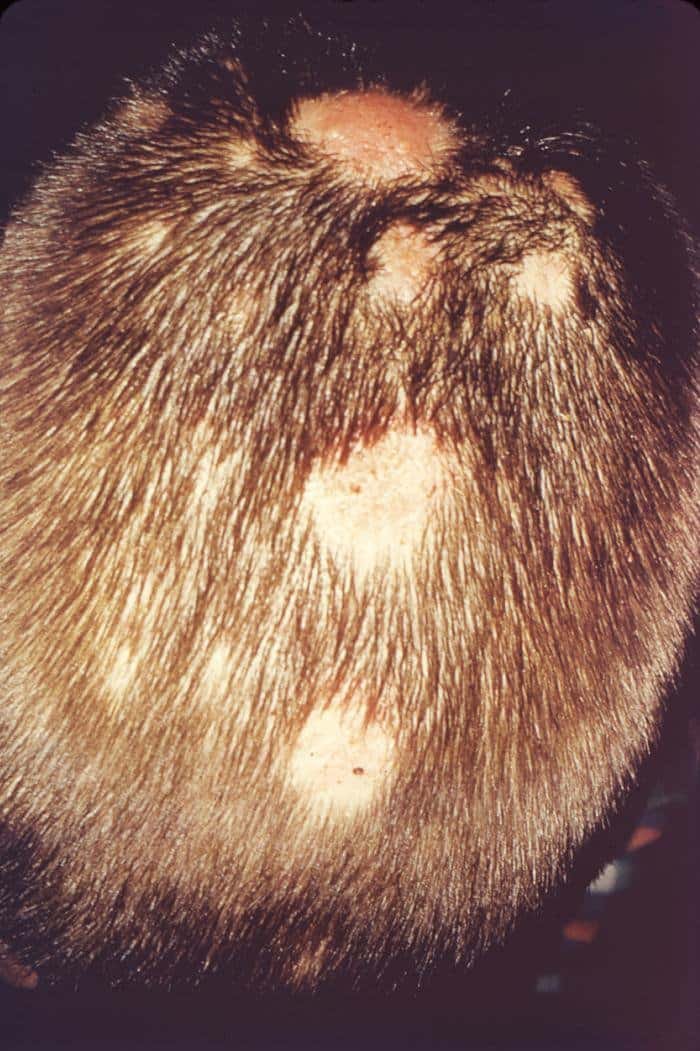 Tinea Capitis