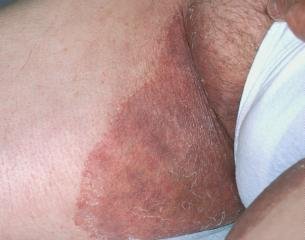 Tinea Cruris