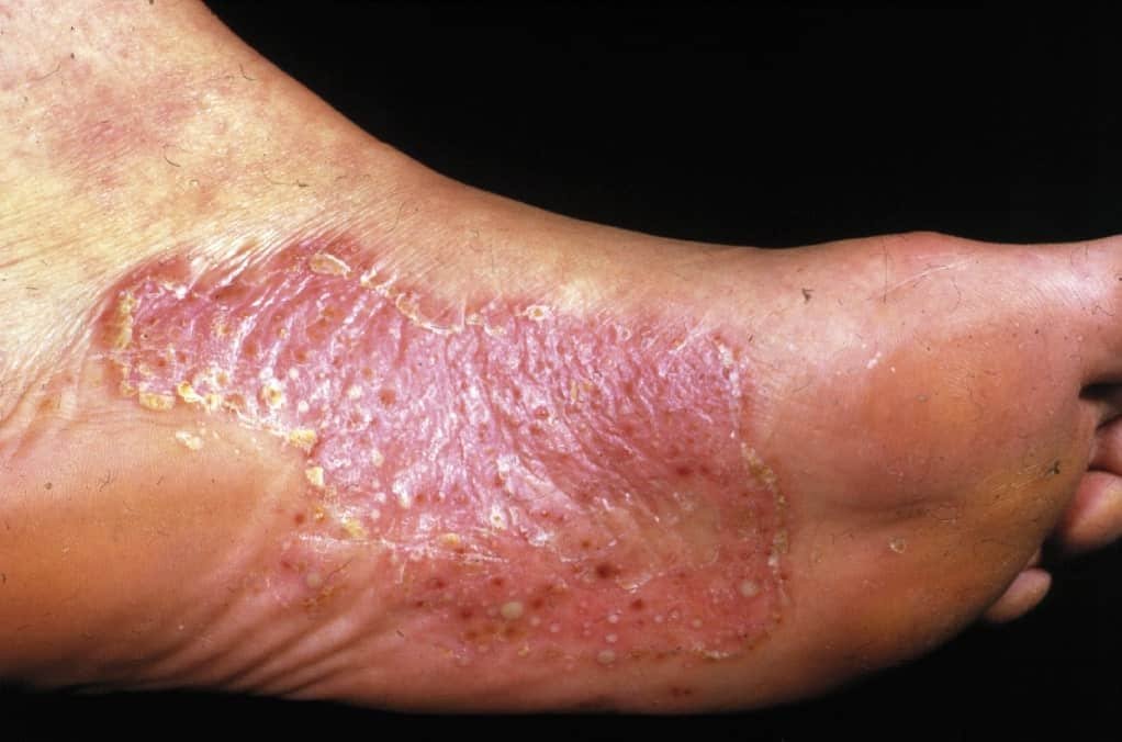 Tinea Pedis