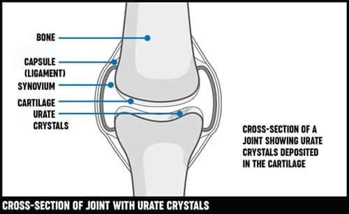 Urate Crystals