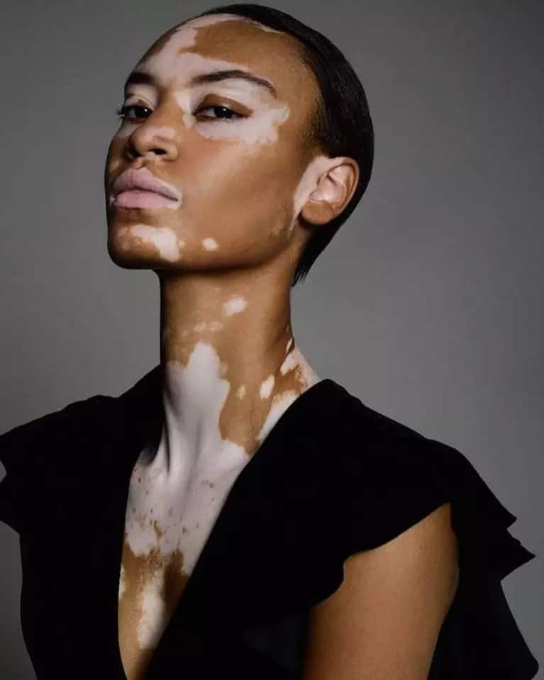 Vitiligo